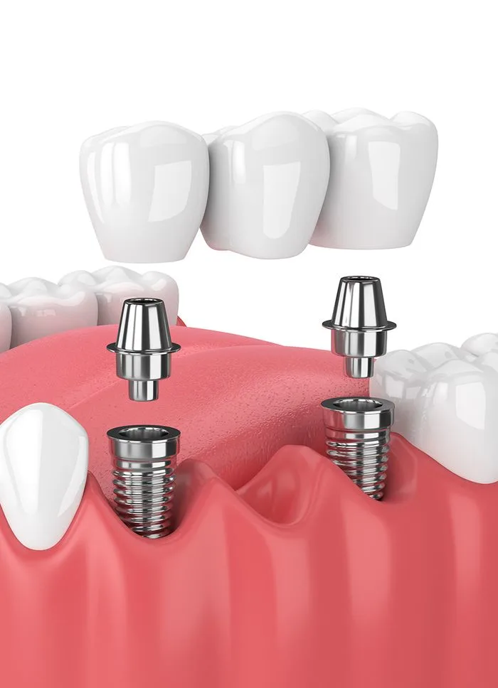 Dental bridge placement