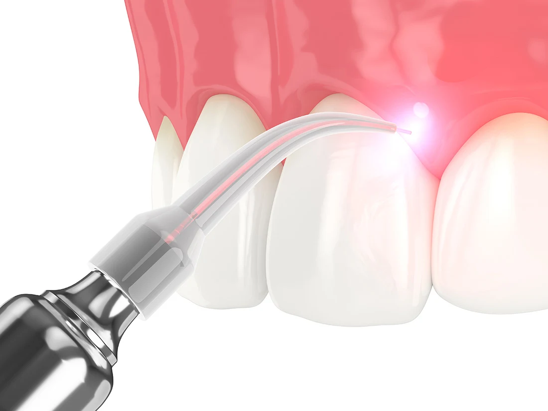 Soft-tissue laser treatment on gums