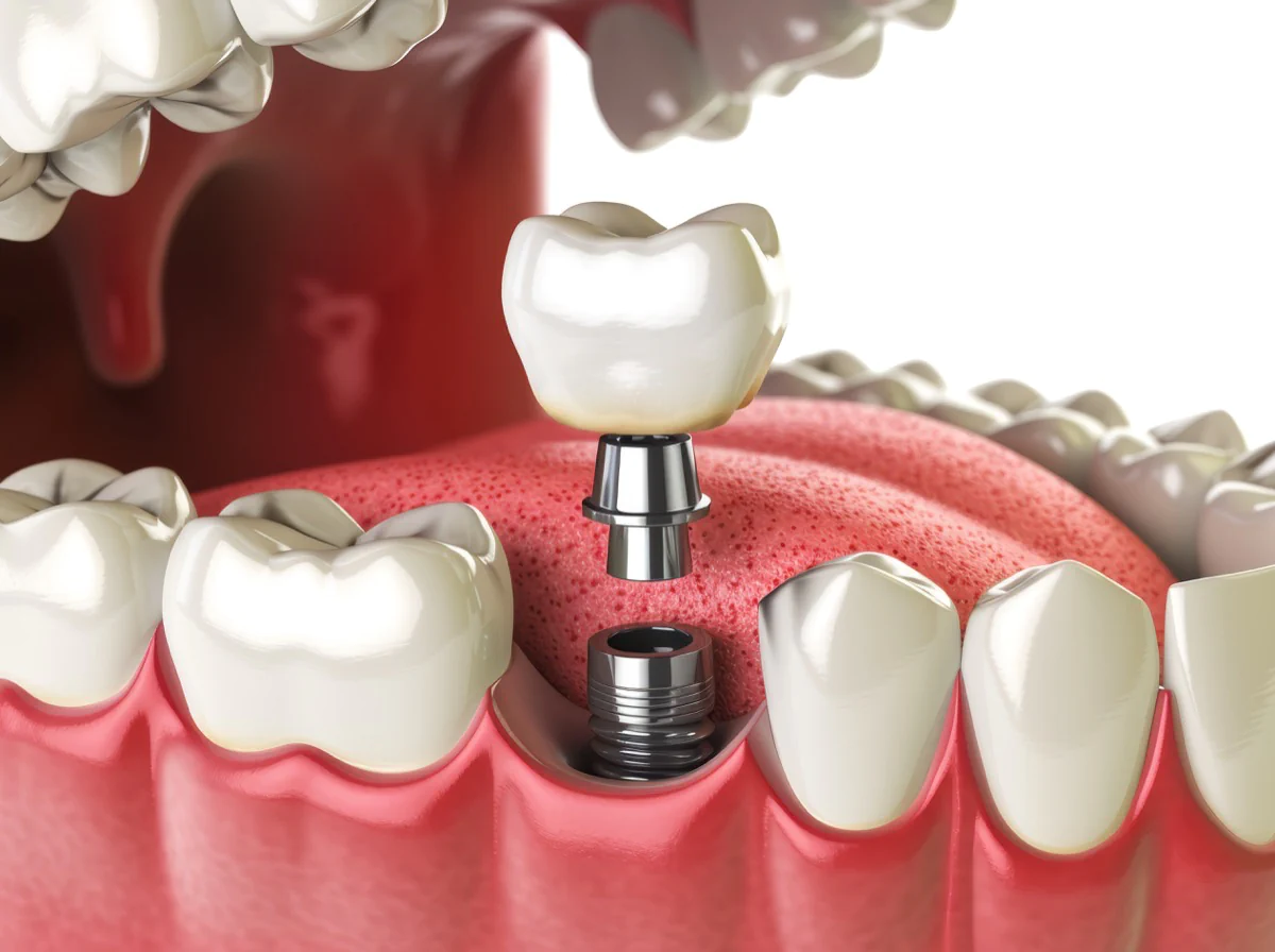 Tooth implant
