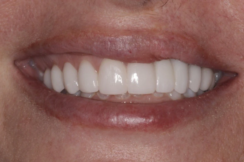 After smile makeover