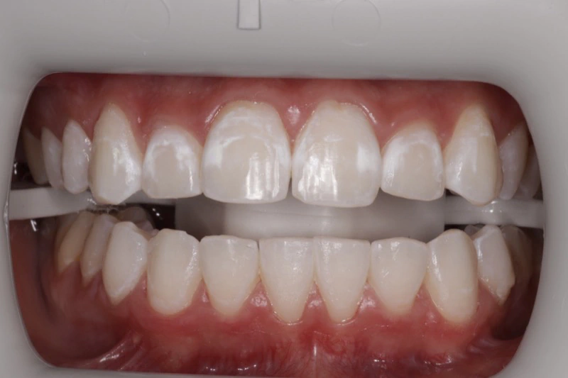 Icon resin infiltration before
